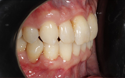 Perfectly aligned smile after Invisalign orthodontics treatment