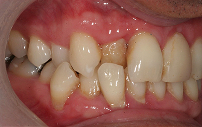 Misaligned teeth before Invisalign orthodontics treatment