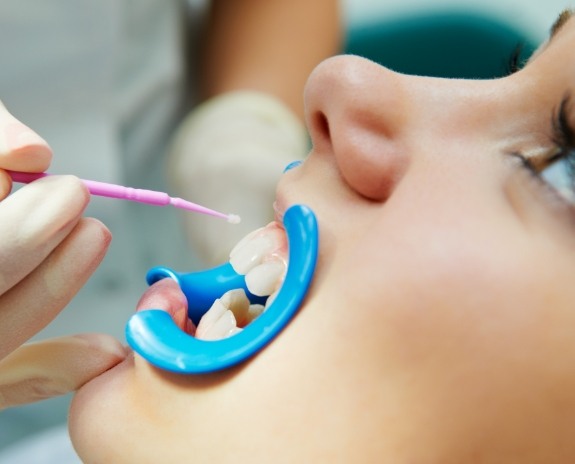 Patient receiving silver diamine fluoride treatment