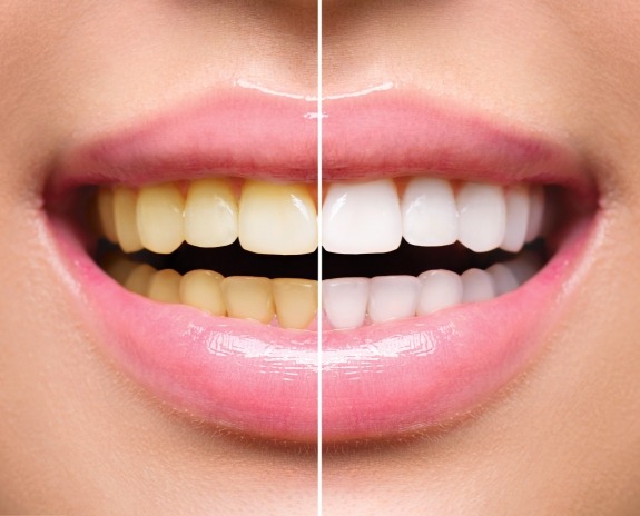 Smile before and after ultradent teeth whitening