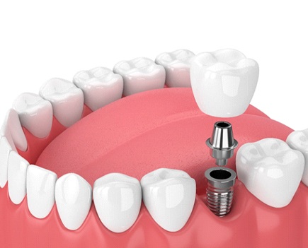 Parts of dental implants in Florence