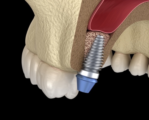 Animated smile with dental implant post in place