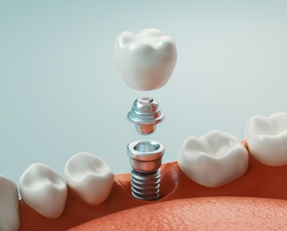 Animated smile showing the four step dental implant process