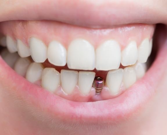 Closeup of smile with dental implant post visible