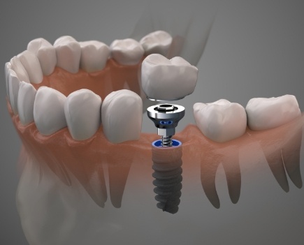 Animated smile during dental implant supported dental crown placement