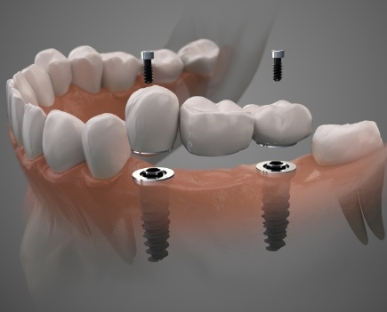 Animated smile during dental implant supported fixed bridge placement