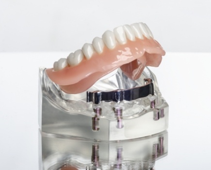 Model smile with dental implant supported denture