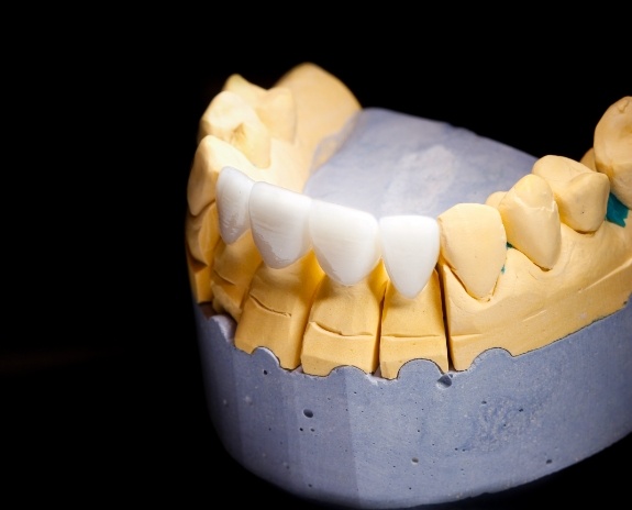 Model smile with dental bridge restoration