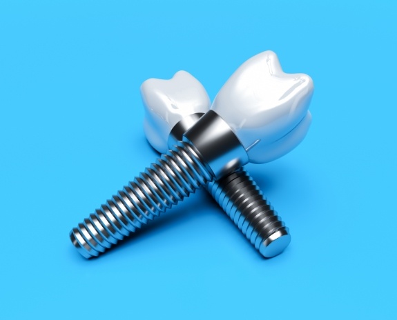 Two dental implant supported dental crowns